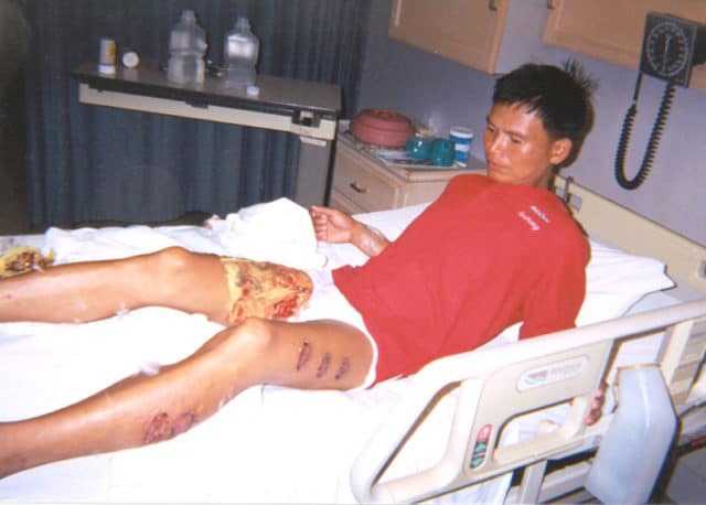 On June 2nd, 2001, three labor camp guards tried to force Tan Yongji (above) to sign a repentance statement renouncing Falun Gong. When he refused, the guards tied him to a post, heated an iron rod in a furnace until it glowed red, and began applying it to his legs. The pain was so excruciating that Tan lost control of his bowel and bladder functions. The guards pressed the rod on his legs 13 times, spacing them out at regular intervals on his flesh, asking him all the while if he would renounce his belief in Falun Gong.