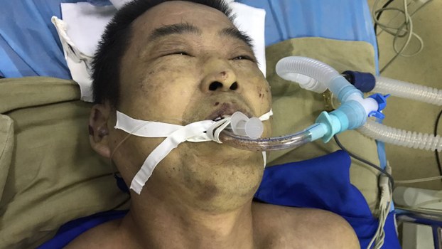 Mr. Yang Yuyong in hospital following torture in custody (Radio Free Asia)