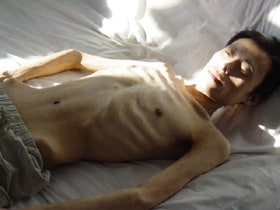 An emaciated and dying Mr. Zhang Zhong after being tortured in the Daqing City Prison (July 2004)