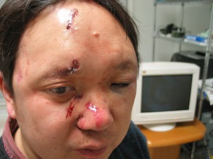 Dr. Peter Yuan Li hours after being beaten and bound in his Atlanta home by assailants who took only computers and documents, leaving other valuables untouched. Dr. Li says the assailants were agents of the Chinese Communist regime aiming to thwart his efforts to expose human rights violations in China.