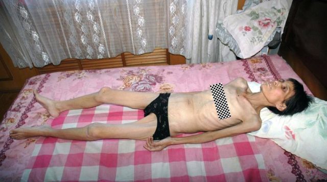 Ms. Sun Shuxiang, emaciated from prolonged torture, photographed ten days after her release from a forced labor camp. 