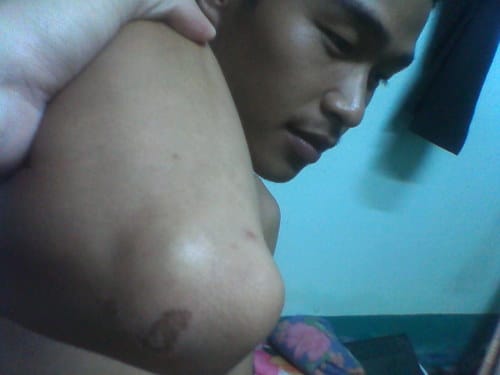 A Vietnamese Falun Gong practitioner shows scars on his elbow where police burned him with a lit cigarette in late August 2011