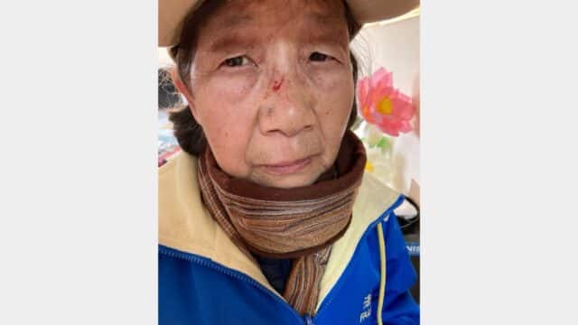 Lü Anmin, a 73-year-old woman, sustained visible facial injuries as a result of an assault incident that occurred on March 25, 2026, in Flushing, New York. (Global Tuidang Center)