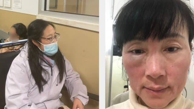 The left image depicts Lydia, who was assaulted at an information booth in Flushing, New York. (Global Tuidang Center) The right image shows Chunping, whose face was severely bruised and swollen as a result of an assault by a bus driver outside the British Museum. (NTD.com)